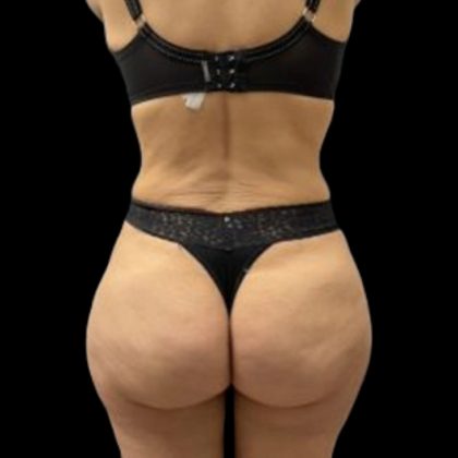 High Definition Liposuction Before & After Patient #5558