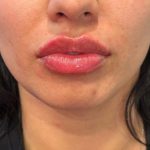 Lip Filler Before & After Patient #9273