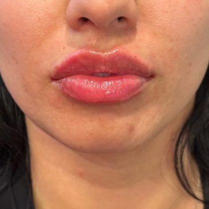 Lip Filler Before & After Patient #9273