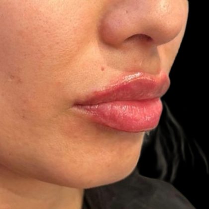 Lip Filler Before & After Patient #9273