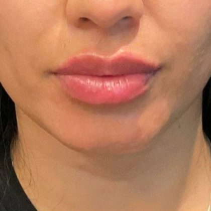 Lip Filler Before & After Patient #9273
