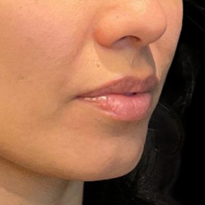 Lip Filler Before & After Patient #9273