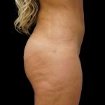 Liposuction Before & After Patient #8991