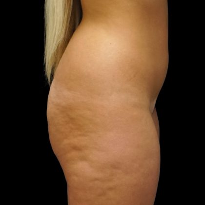 Liposuction Before & After Patient #8991