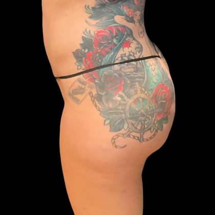 Liposuction Before & After Patient #9028