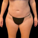 Liposuction Before & After Patient #9028