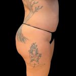 Liposuction Before & After Patient #9028