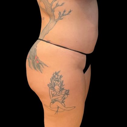 Liposuction Before & After Patient #9028