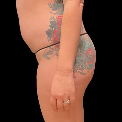 Liposuction Before & After Patient #9028