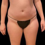 Liposuction Before & After Patient #9028