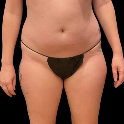 Liposuction Before & After Patient #9028