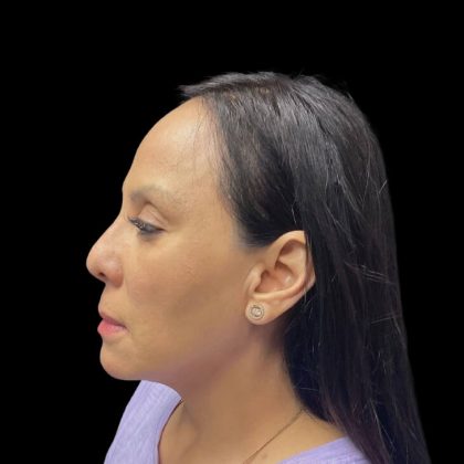 Liquid Rhinoplasty Before & After Patient #9168