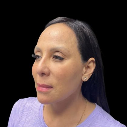 Liquid Rhinoplasty Before & After Patient #9168