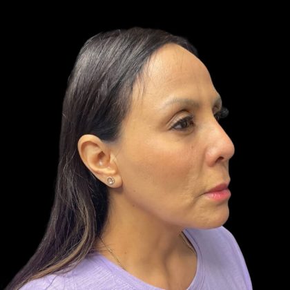 Liquid Rhinoplasty Before & After Patient #9168