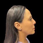 Liquid Rhinoplasty Before & After Patient #9168