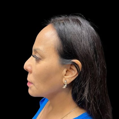 Liquid Rhinoplasty Before & After Patient #9168