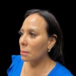 Liquid Rhinoplasty Before & After Patient #9168