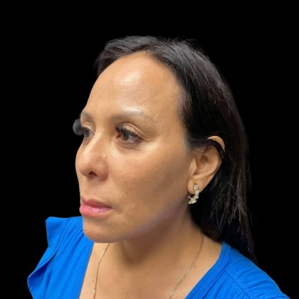 Liquid Rhinoplasty Before & After Patient #9168