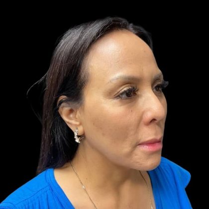 Liquid Rhinoplasty Before & After Patient #9168
