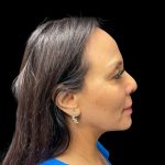 Liquid Rhinoplasty Before & After Patient #9168