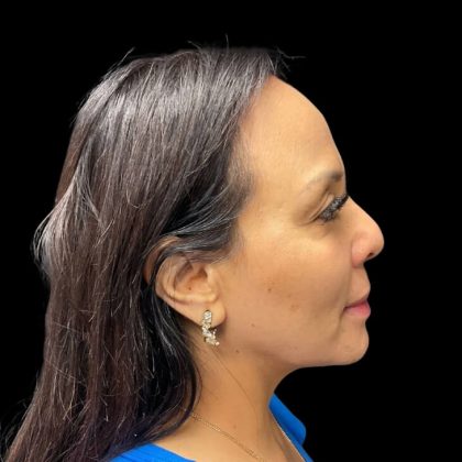 Liquid Rhinoplasty Before & After Patient #9168