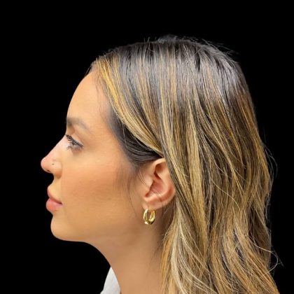 Liquid Rhinoplasty Before & After Patient #9614
