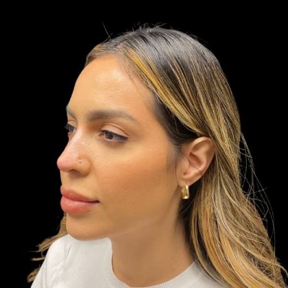 Liquid Rhinoplasty Before & After Patient #9614