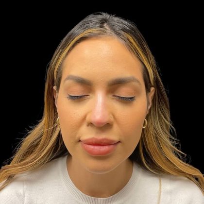 Liquid Rhinoplasty Before & After Patient #9614