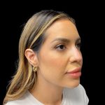 Liquid Rhinoplasty Before & After Patient #9614