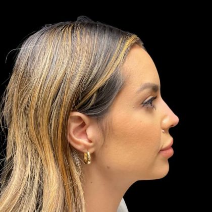 Liquid Rhinoplasty Before & After Patient #9614