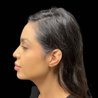 Liquid Rhinoplasty Before & After Patient #9614