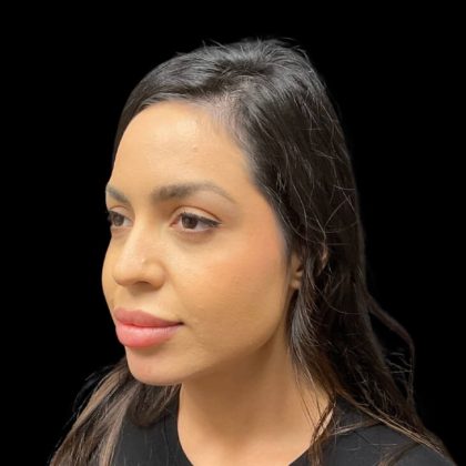Liquid Rhinoplasty Before & After Patient #9614