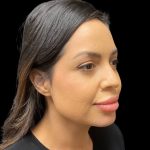 Liquid Rhinoplasty Before & After Patient #9614