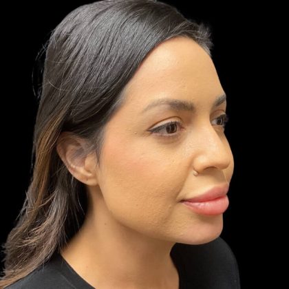 Liquid Rhinoplasty Before & After Patient #9614