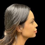 Liquid Rhinoplasty Before & After Patient #9614
