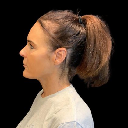 Facelift Before & After Patient #9633