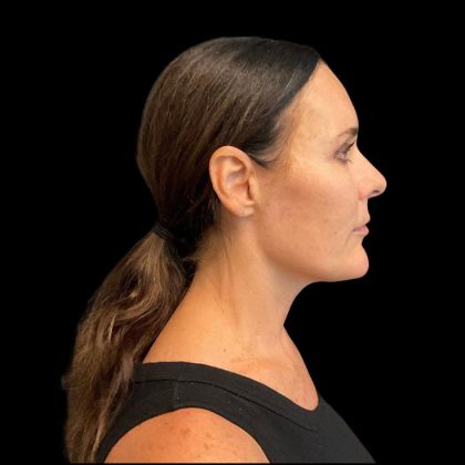 Facelift Before & After Patient #9633