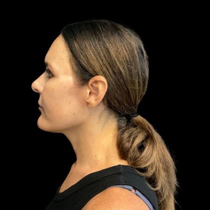 Facelift Before & After Patient #9633
