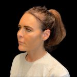 Facelift Before & After Patient #9633
