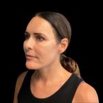 Facelift Before & After Patient #9633