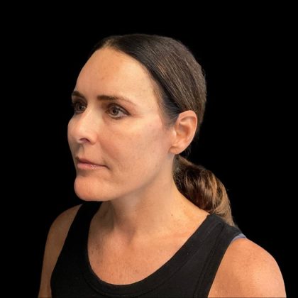 Facelift Before & After Patient #9633
