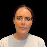 Facelift Before & After Patient #9633