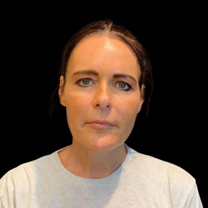 Facelift Before & After Patient #9633
