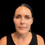 Facelift Before & After Patient #9633