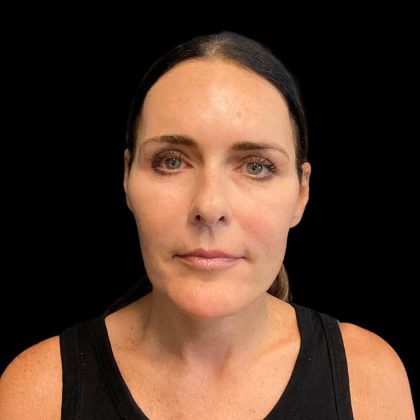 Facelift Before & After Patient #9633