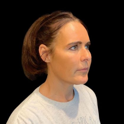 Facelift Before & After Patient #9633