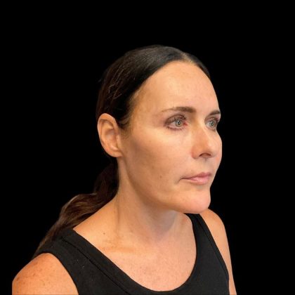 Facelift Before & After Patient #9633