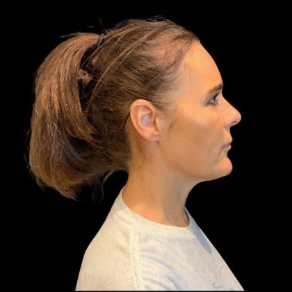 Facelift Before & After Patient #9633