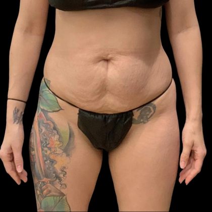 Brazilian Butt Lift Before & After Patient #6105