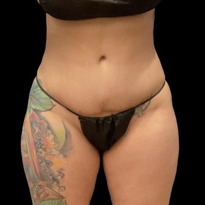 Brazilian Butt Lift Before & After Patient #6105